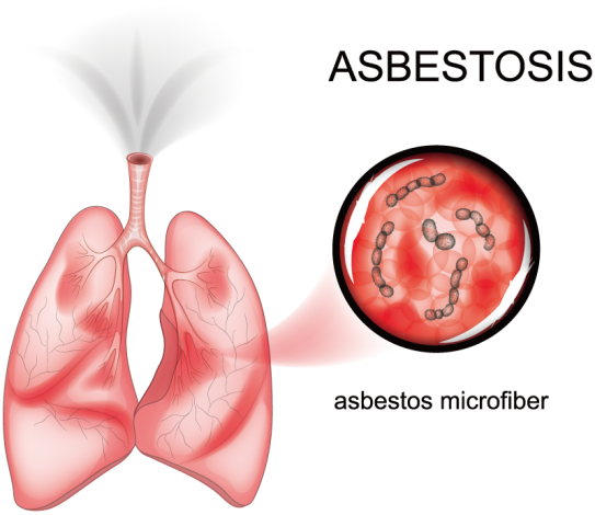 アスベスト繊維が肺に蓄積する様子を示したイラスト